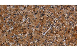 Immunohistochemistry of paraffin-embedded Human prostate cancer using CYP1A2 Polyclonal Antibody at dilution of 1:40 (CYP1A2 Antikörper)