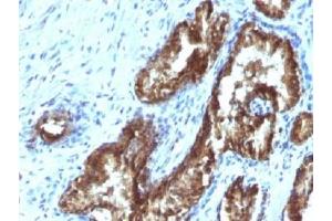 IHC testing of FFPE human prostate carcinoma with TDP2 antibody (clone TDP2/1258). (TDP2 Antikörper)