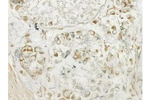 ABIN6262558 and ABIN6277619 at 1/100 staining human gastric carcinoma by IHC-P. (IL27 Antikörper  (Internal Region))