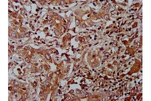 IHC image of ABIN7165027 diluted at 1:400 and staining in paraffin-embedded human liver cancer performed on a Leica BondTM system. (AHNAK2 Antikörper  (AA 195-349))