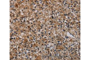 Immunohistochemistry of Human prostate cancer using TP53INP1 Polyclonal Antibody at dilution of 1:50 (TP53INP1 Antikörper)