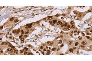 Immunohistochemistry of paraffin-embedded Human colon cancer using NUP50 Polyclonal Antibody at dilution of 1:30 (NUP50 Antikörper)