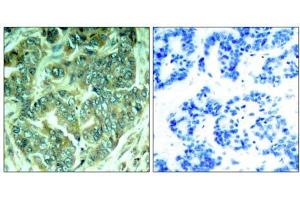 Immunohistochemical analysis of paraffin-embedded human breast carcinoma tissue, using p62Dok (phospho- Tyr398) antibody (E011277). (DOK1 Antikörper  (pTyr398))