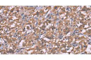 Immunohistochemistry of paraffin-embedded Human thyroid cancer using Histamine H3 Receptor Polyclonal Antibody at dilution of 1:50 (HRH3 Antikörper)