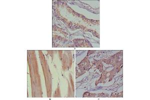 Immunohistochemical analysis of paraffin-embedded human lung cancer (A), muscles (B) and breast cancer (C) using MUSK antibody with DAB staining. (MUSK Antikörper  (AA 24-209))