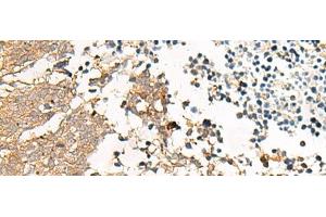 Immunohistochemistry of paraffin-embedded Human lung cancer tissue using GPR22 Polyclonal Antibody at dilution of 1:50(x200) (GPR22 Antikörper)