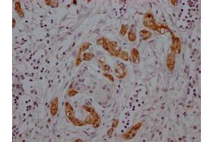 IHC image of ABIN7127620 diluted at 1:100 and staining in paraffin-embedded human pancreatic cancer performed on a Leica BondTM system. (Rekombinanter Midkine Antikörper)