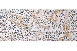 Immunohistochemistry of paraffin-embedded Human breast cancer tissue using GMPR Polyclonal Antibody at dilution of 1:60(x200)