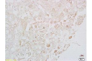 Formalin-fixed and paraffin embedded human cervical carcinoma labeled with Anti- LONP1 Polyclonal Antibody, Unconjugated  at 1:200 followed by conjugation to the secondary antibody
