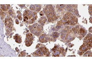 ABIN6277475 at 1/100 staining Human liver cancer tissue by IHC-P. (FSHR Antikörper  (Internal Region))