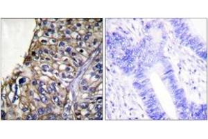 Immunohistochemistry analysis of paraffin-embedded human lung carcinoma tissue, using Claudin 7 Antibody.