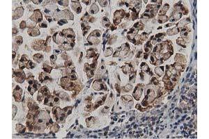 Immunohistochemical staining of paraffin-embedded Adenocarcinoma of Human colon tissue using anti-ACAT2 mouse monoclonal antibody.