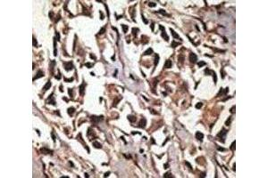 IHC analysis of FFPE human breast carcinoma tissue stained with the PRMT7 antibody (PRMT7 Antikörper  (AA 660-692))
