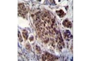 Immunohistochemistry analysis in formalin fixed and paraffin embedded human bladder carcinoma reacted with FRAT2 Antibody (C-term) followed by peroxidase conjugation of the secondary antibody and DAB staining. (FRAT2 Antikörper  (C-Term))