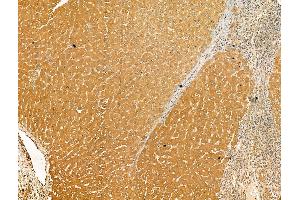 ABIN7094530 and ABIN7098579 at 1/100 staining Human liver cancer and adjacent normal tissues by IHC-P.