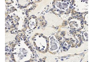 ABIN6257851 and ABIN6275627 at 1/100 staining human ovarian cancer by IHC-P. (TSSK4 Antikörper  (Internal Region))
