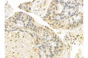 Rel Mouse Monoclonal Antibody at 1/100 staining human lung cancer and adjacent non-tumor tissue by IHC-P.
