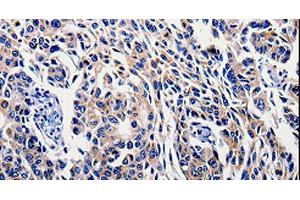 Immunohistochemistry of paraffin-embedded Human lung cancer tissue using IL10RB Polyclonal Antibody at dilution 1:60 (IL10RB Antikörper)
