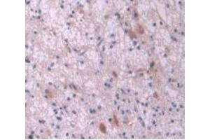 IHC-P analysis of Human Glioma Tissue, with DAB staining. (IL-2 Antikörper  (AA 21-153))