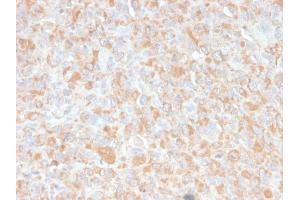 Formalin-fixed, paraffin-embedded human Histiocytoma stained with TNF alpha Mouse Monoclonal Antibody (4C6-H8). (TNF alpha Antikörper  (AA 115-130))