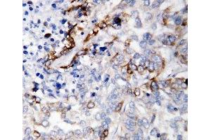 IHC-P: LAMC2 antibody testing of human lung cancer tissue (LAMC2 Antikörper  (C-Term))