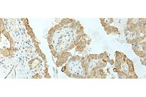 Immunohistochemistry of paraffin-embedded Human thyroid cancer tissue using ETAA1 Polyclonal Antibody at dilution of 1:25(x200) (ETAA1 Antikörper)