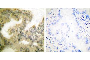 P-peptide - +Immunohistochemical analysis of paraffin-embedded human lung carcinoma tissue using Cyclin D3 (Phospho-Thr283) Antibody (#A0418). (Cyclin D3 Antikörper  (pThr283))