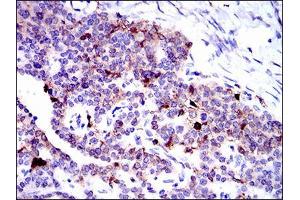 Immunohistochemical analysis of paraffin-embedded ovarian cancer tissues using ANXA1 mouse mAb with DAB staining. (Annexin a1 Antikörper  (AA 144-248))