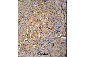 PRE1 antibody (N-term) (ABIN652240 and ABIN2841004) immunohistochemistry analysis in forlin fixed and paraffin embedded hun bladder carcino followed by peroxidase conjugation of the secondary antibody and DAB staining. (MAPRE1 Antikörper  (N-Term))