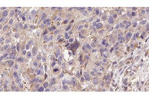 ABIN6273000 at 1/100 staining Human Melanoma tissue by IHC-P. (Glutathione Peroxidase 7 Antikörper  (Internal Region))