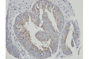 IHC-P Image Immunohistochemical analysis of paraffin-embedded human mixed ovarian cancer, using CYP4A11, antibody at 1:100 dilution.