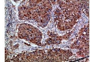 Immunohistochemical analysis of paraffin-embedded human-lung-cancer, antibody was diluted at 1:200 (Integrin alpha 1 Antikörper  (AA 920-980))
