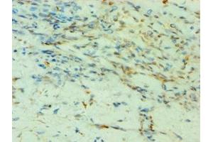 Immunohistochemistry of paraffin-embedded human breast cancer using ABIN7155523 at dilution of 1:100 (SMYD3 Antikörper  (AA 199-428))