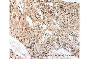 Immunohistochemistry of Human esophagus cancer using SLC1A7 Polyclonal Antibody at dilution of 1:60 (SLC1A7 Antikörper)