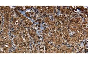 Immunohistochemistry of paraffin-embedded Human thyroid cancer using GLO1 Polyclonal Antibody at dilution of 1:50 (GLO1 Antikörper)