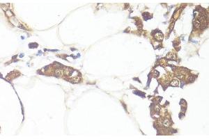 Immunohistochemistry of paraffin-embedded Human breast cancer using SMAD7 Polyclonal Antibody at dilution of 1:100 (40x lens). (SMAD7 Antikörper)