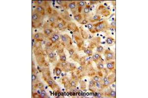 Formalin-fixed and paraffin-embedded human hepatocarcinoma reacted with HYOU1 Antibody , which was peroxidase-conjugated to the secondary antibody, followed by DAB staining. (HYOU1 Antikörper  (AA 274-303))