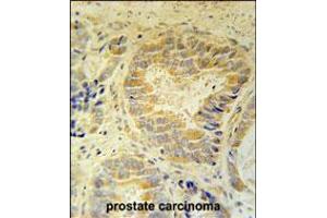 FAM105B Antibody immunohistochemistry analysis in formalin fixed and paraffin embedded human prostate carcinoma followed by peroxidase conjugation of the secondary antibody and DAB staining. (FAM105B Antikörper  (AA 99-128))