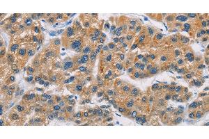 Immunohistochemistry of paraffin-embedded Human liver cancer tissue using CERK Polyclonal Antibody at dilution 1:30 (CERK Antikörper)