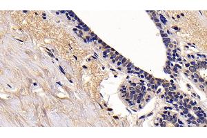 Detection of RIPK1 in Human Mammary gland Tissue using Polyclonal Antibody to Receptor Interacting Serine Threonine Kinase 1 (RIPK1) (RIPK1 Antikörper  (AA 17-289))