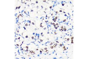 Immunohistochemistry of paraffin-embedded Human liver cancer using MYEF2 Rabbit pAb (ABIN7268721) at dilution of 1:100 (40x lens). (MYEF2 Antikörper  (AA 1-120))