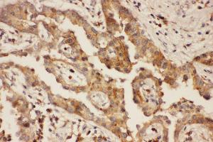 Anti-CXCR3 Picoband antibody,  IHC(P): Human Lung Cancer Tissue (CXCR3 Antikörper  (AA 1-368))