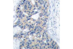 Immunohistochemistry of paraffin-embedded human breast carcinoma using Phospho-STMN1-S38 antibody (ABIN2987644). (Stathmin 1 Antikörper  (pSer38))