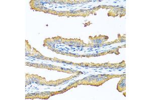Immunohistochemistry of paraffin-embedded human prostate using TAC1 antibody at dilution of 1:100 (40x lens).