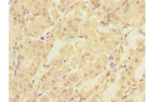 Immunohistochemistry of paraffin-embedded human gastric cancer using ABIN7163386 at dilution of 1:100 (PMM2 Antikörper  (AA 1-246))