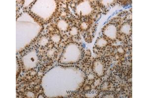 Immunohistochemistry of Human thyroid cancer using S100A1 Polyclonal Antibody at dilution of 1:70 (S100A1 Antikörper)