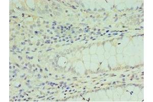Immunohistochemistry of paraffin-embedded human colon cancer using ABIN7172637 at dilution of 1:100 (SOX6 Antikörper  (AA 1-74))