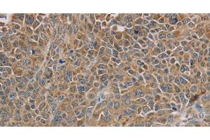 Immunohistochemistry of paraffin-embedded Human ovarian cancer tissue using NDUFS7 Polyclonal Antibody at dilution 1:40 (NDUFS7 Antikörper)