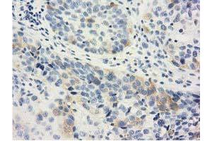 Immunohistochemical staining of paraffin-embedded Carcinoma of Human bladder tissue using anti-LIN7B mouse monoclonal antibody. (LIN7B Antikörper)