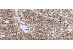 Immunohistochemistry of paraffin-embedded Human liver cancer tissue using UBE4B Polyclonal Antibody at dilution of 1:40(x200)